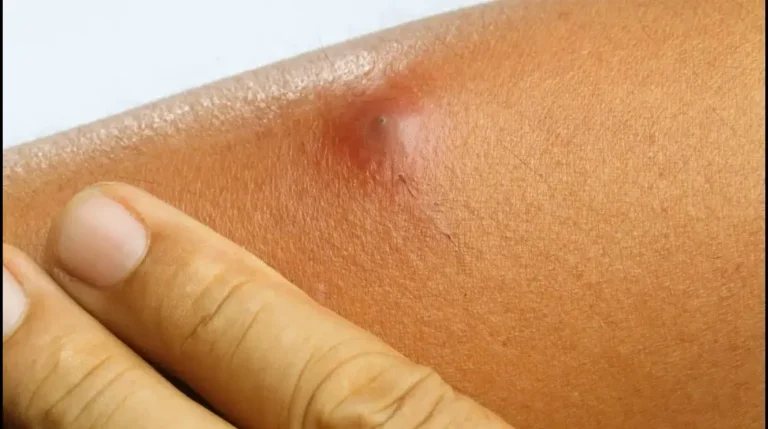 Can Stress Cause Boils?