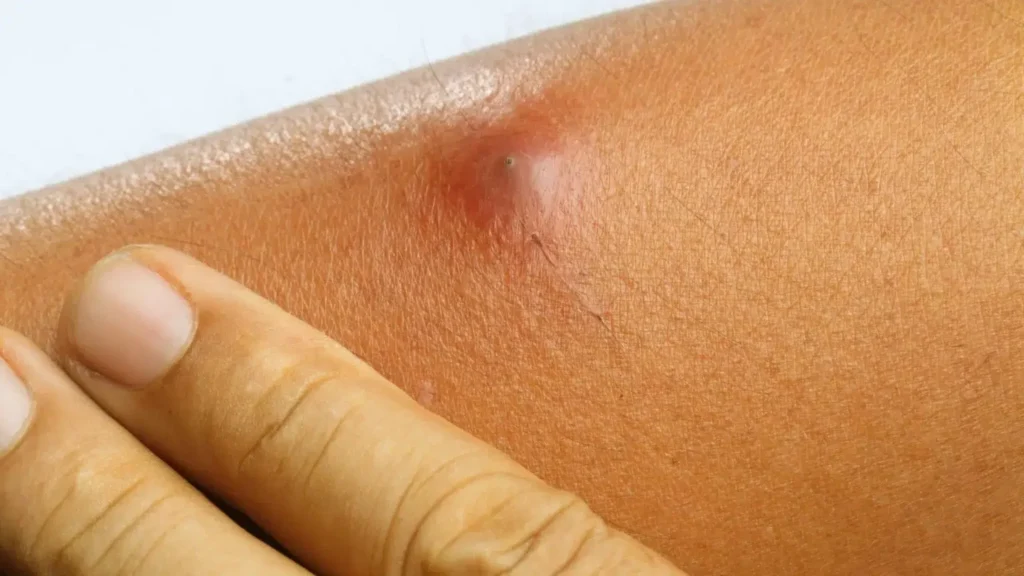 Can stress cause boils